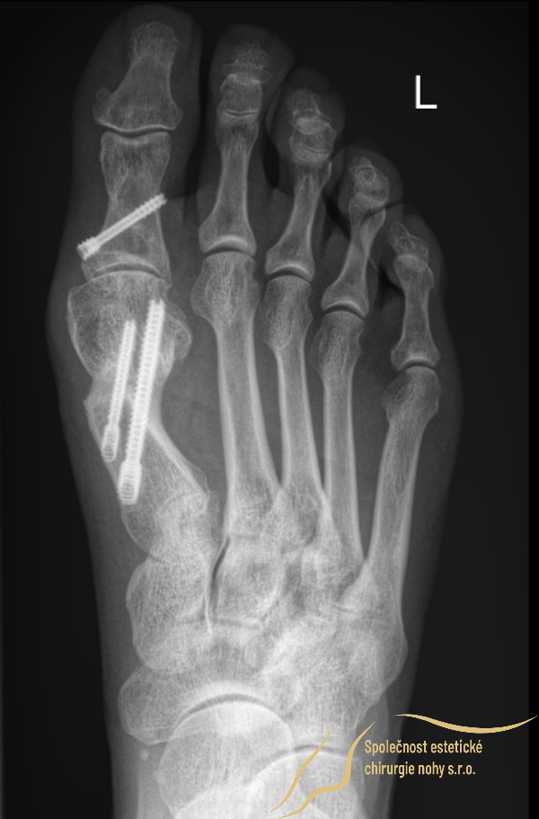 rentgenový snímek zhojených kostí vbočeného palce